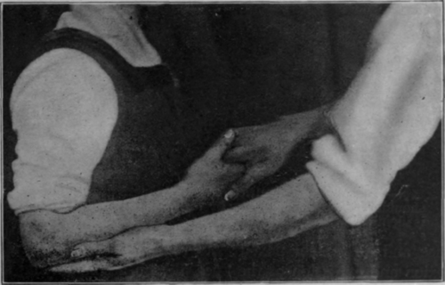 Fig. 28.   The same as Fig. 27, showing elbow flexed. Note again the rotation of forearm