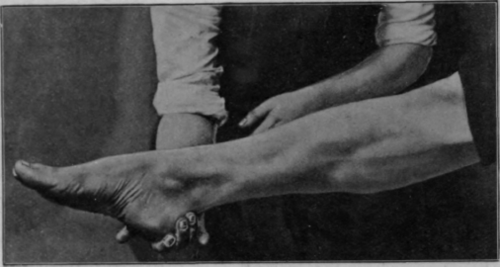 Fig. 3.   Contour with muscles contracted, the limb being supported only at the heel. The contour is more nearly circular than in Figs. 1 or 2