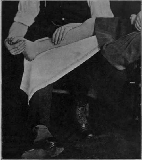 Fig. 30.   To show flexion of the toes with dorsi flexion of the ankle. Note the knee is bent