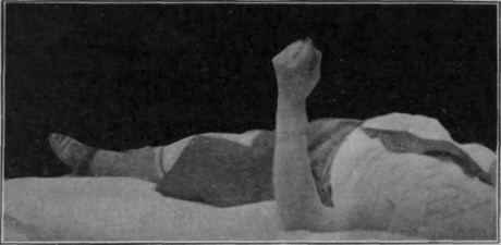 Fig. 41.   To show the position for free rotation of the forearm, the patient being recumbent