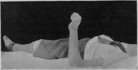 Fig. 42.   To show the same position as in Fig. 41, free movement having been performed from almost full supination to full pronation