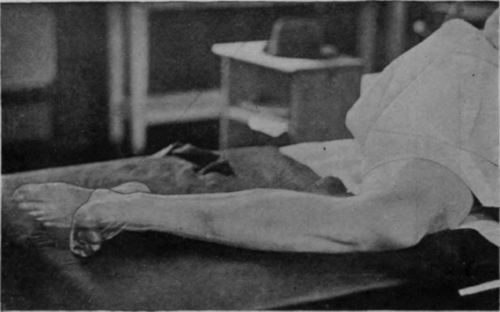 Fig. 47.   To show the position for free movement of the ankle. Movement of the toes in this position is also free.