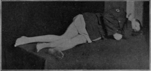 Fig. 48.   To show the position for free movement of the knee. If the patient's left thigh were drawn back, the knee well flexed, and if the right thigh were drawn forward, extension of the right knee would be assisted by gravity