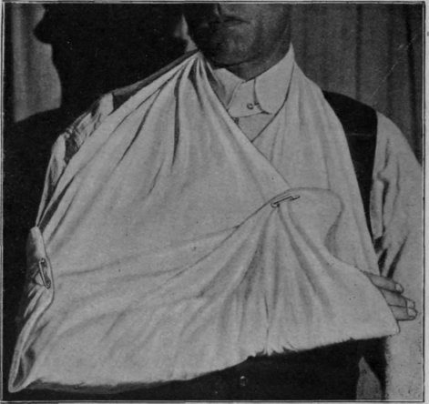 Fig. 63.   Correct position for carrying the forearm in a sling