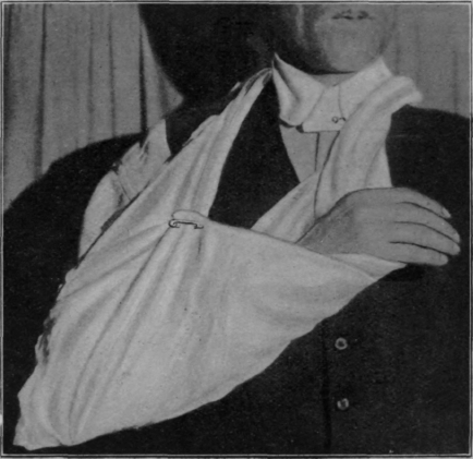 Fig. 78.   To show how flexion may be relaxed