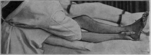 Fig. 82.   To show another method of mobilising the knee during the early stages. The right hand of the masseur alternately raises and lowers the foot