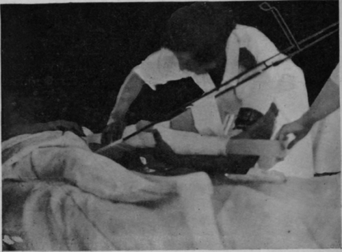 Fig. 83.   To show the administration of a dose of relaxed movement to the knee joint of a patient with fractured femur, before union is firm enough to allow removal of the extension. It was in this manner that treatment was given to the patient shown in Figs. 86 and 87 on and after the tenth day from the receipt of a septic G.S.W. of middle third of the shaft of the femur. The ordinary surgical treatment of the wound, drainage, irrigation, subsequent sequestrotomy, etc., was carried out concurrently