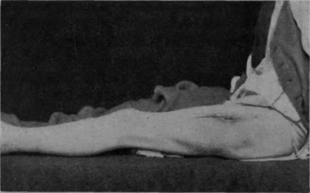 Fig. 84.   This and the subsequent photo were taken of a patient before discharge from the Special Surgical Hospital, Shepherd's Bush. He sustained the ordinary septic G.S.W. of femur on August 24th, 1918. He was treated on a Thomas' knee splint. Massage and relaxed movements were begun on September 21st. Flexion through 55� was secured by the middle of October. A month later he was taken off individual treatment and placed in a special class for exercise without weight, and by the 25th November his knee could be bent to a right angle. The muscular development and power is shown in Fig. 85
