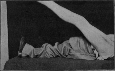 Fig. 85.   Same patient as that shown in Fig. 84. Note the power of full extension of the knee and general good condition. Photo taken (about) March 3rd, 1919. There was no visible deformity or shortening