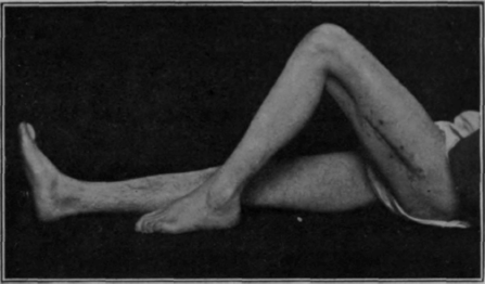 Fig. 86.   The second of seven cases who were taken off individual massage treatment, and treated thenceforth in a special class for exercise within three months of sustaining septic gunshot wounds of the femur. History