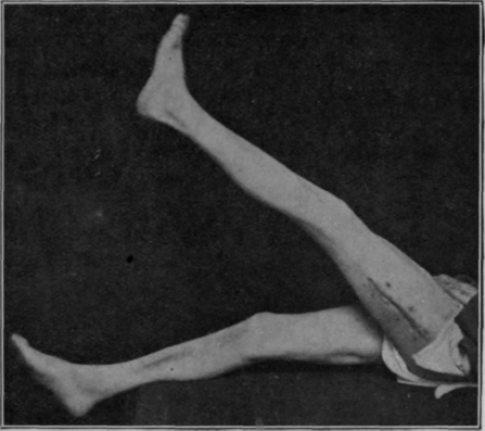Fig. 87.   The same patient as that shown in Fig. 86. The photos were taken about six months after receipt of wound. Treatment began in both cases shown while the through and through wounds were widely open. The cases were kindly sent to me for treatment by Mr. Trethowan