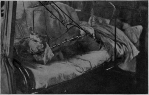 Fig. 88.   To show the application of a common form of calliper extension as applied to a fractured femur. Note that full extension of the knee is impossible, as the top of the shin meets the cross of the calliper before this position is reached