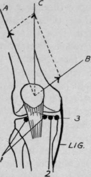 Fig. 91.   (After Robert Jones.) To show how wasting of the vastus internus alters the resultant of the direction of the pull of the whole quadriceps, thus causing the movement of the patella to deviate from its normal direction