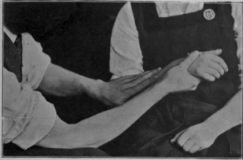 Fig. 93.   To show first position when trying to secure the last few degrees of supination