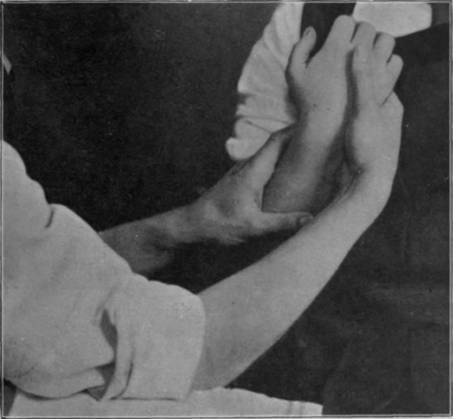 Fig. 94   To show the second position when trying to secure the last few degrees of supination