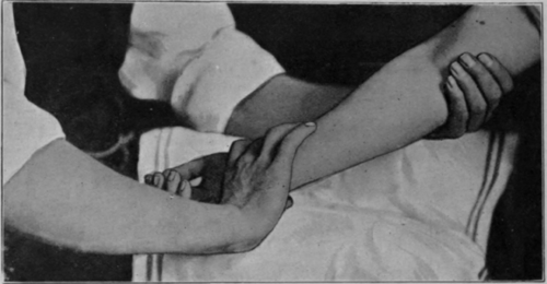 Fig. 95.   To show the final position when trying to secure the last few degrees of supination. The passage from the position shown in Fig. 94 to that here depicted should be rapid