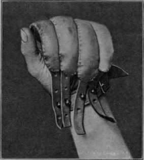 Fig. 96.   To show flexion of fingers by constant tension, the hand being placed in a glove