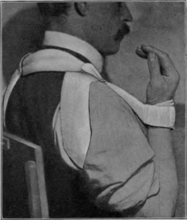 Fig. 97.   To show flexion of elbow being secured by use of the cuff and collar. This shows how the elbow can be fully flexed and supination secured