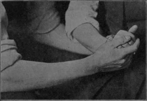 Fig. i6.   To show flexion of fingers with extension of the wrist
