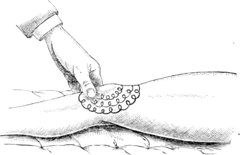 Fig. 113.   Friction with the Thumb in Cases of Synovitis of the Knee joint
