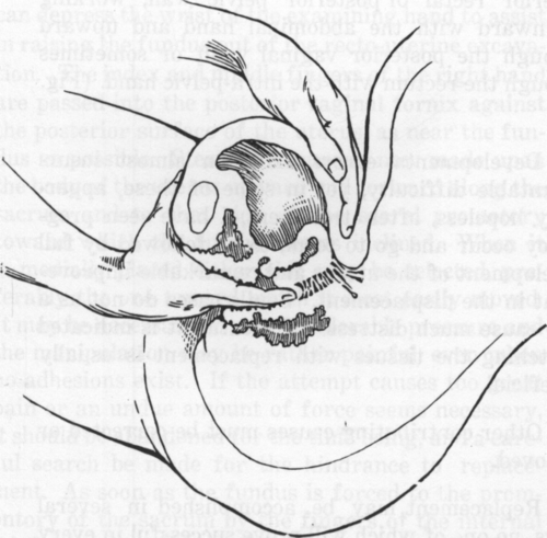 Fig. 32. Loosening the Uterus from the Posterior Pelvic Wall.