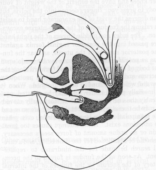 Fig. 33. Replacement of a Retroversion. First Step.