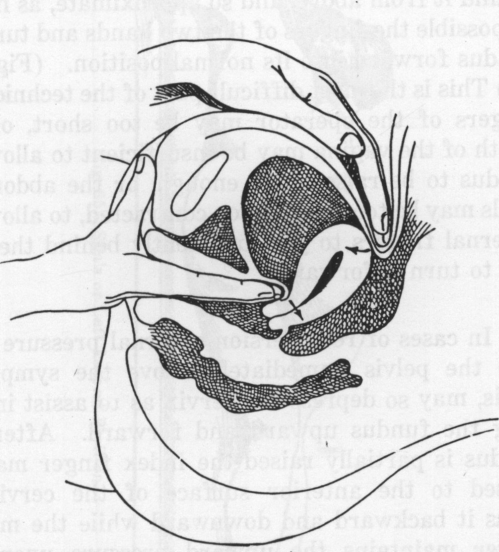 Fig. 34. Replacement of a Retroversion. Second Step.