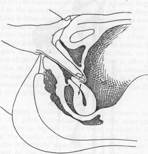 Fig. 36. Replacement of a Retroversion. Second Method.