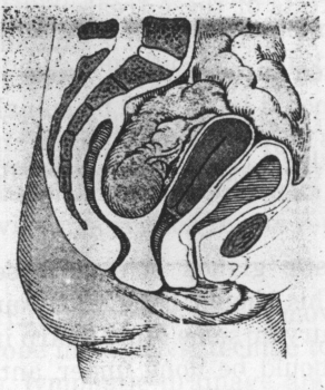 Fig. 45. Left sided Pyosalpinx.