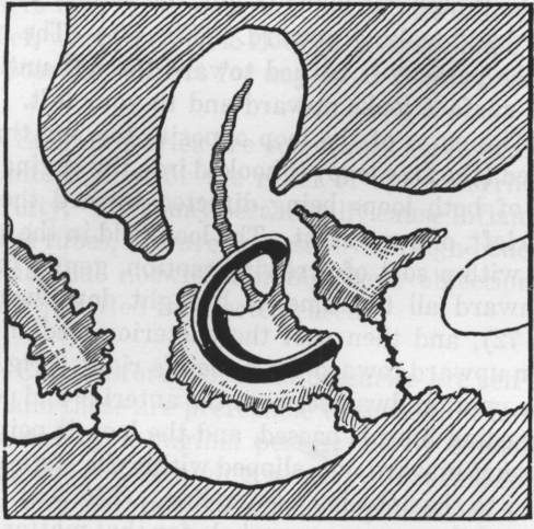 Fig. 75. Gehrung Pessary in Position.