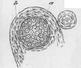 cyst formation in a medullary carcinoma
