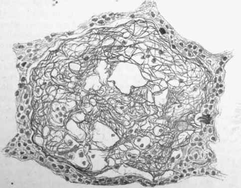 A lung alveolus in acute pneumonia.