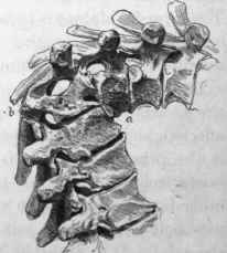 Acute curvature from tuberculosis.