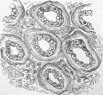 Amyloid degeneration of the basement membrane of uriniferous tubules.
