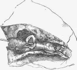 Aneurysm in a bronchiectatic cavity.