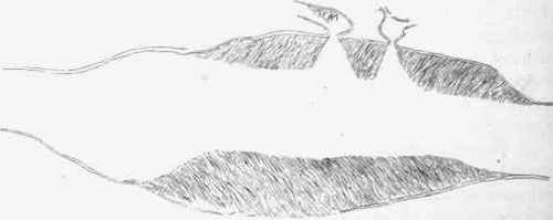 Aneurysm of the abdominal aorta with clots tunnelled so as to allow the blood to reach the branches.