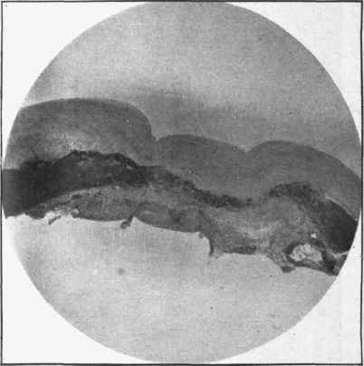 Beginnings of an aneurysm in aorta, a, Media; b, intima.