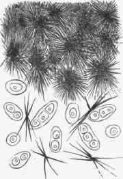 Cartilage of joint in gout, with crystals of urate of sodium.