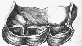 Congenital malformation of aortic valve. There are two curtains, but the larger one shows a partial division. (Peacock).