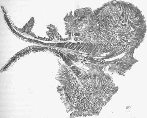 Cylinder celled epithelioma of large intestine.