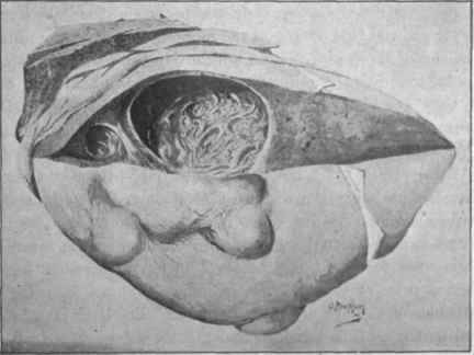 Cystic cancer of liver. (From a painting by Dr. A. Maophail).