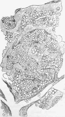 Diffuse amyloid spleen. The swollen and translucent tissue of the pulp (a) is shown, x 400. (After Kyber).