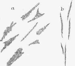 Fatty degeneration in an atheromatous aorta.
