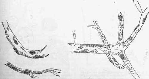 Fatty degeneration in the cerebral vessels in softening of the brain.