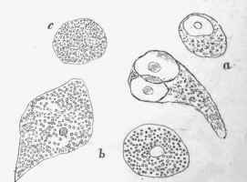 Fatty degeneration of cells in a cancer of the mamma; a, slighty affected; b, more so; c, completely fatty   the compound granular corpuscle, x 350.