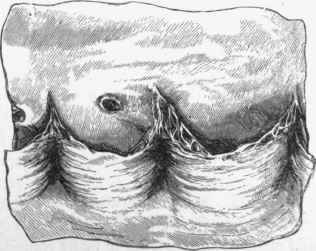 Fenestration of the marginal parts of the aortic valve.