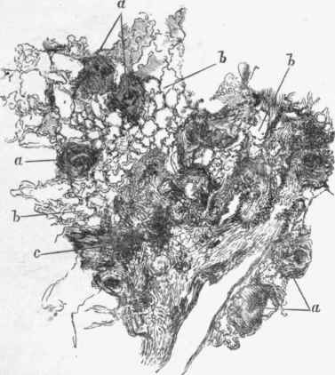 Fibroid phthisis, a, a, tubercles in connective tissue, some close to a bronchus.