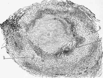 Fibroid phthisis, a, bronchus plugged and caseous; b, b, wall of bronchus infiltrated with round cells and tubercles; c, tubercle in wall.