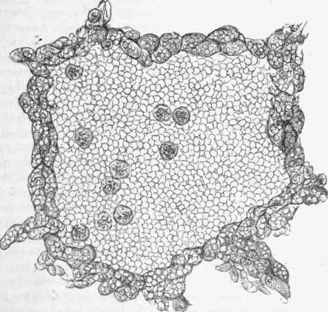 From a haemorrhagic infarction of the lung.