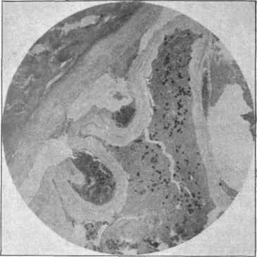From a .shrunken hydatid of the liver.
